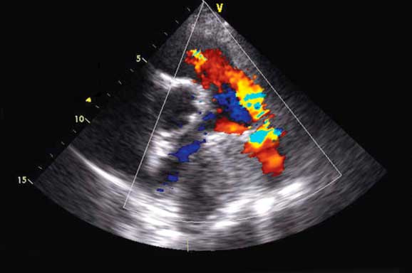 Эхокардиографическая диагностика недостаточности клапана легочной артерии