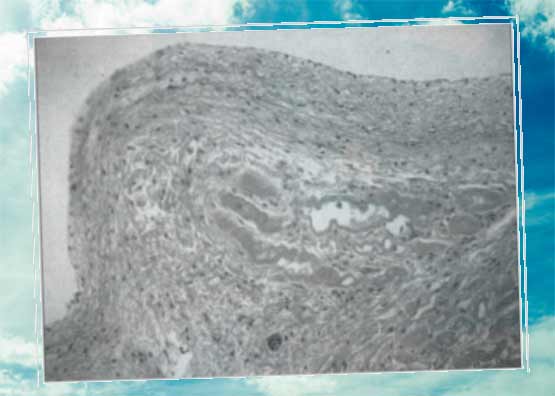 Микрофотография миокарда левого желудочка собаки, больной фиброэластозом эндокарда