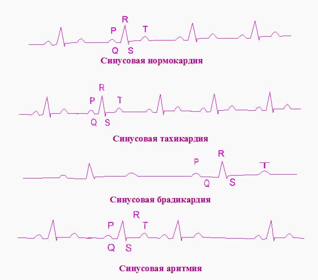 Электрокардиографическая диагностика нарушений сердечного ритма