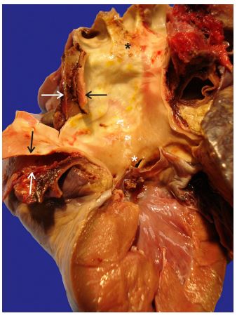 A 4-mm intimal tear was identified within the non-coronary aortic valve sinus