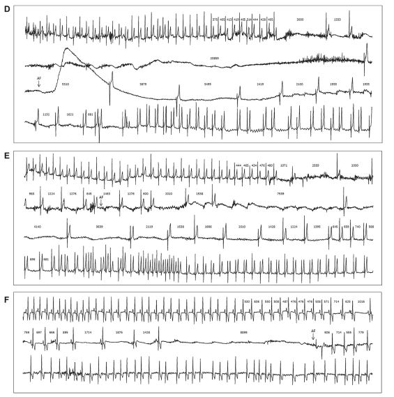 Electrocardiogram recorded during a syncopal episode in old male Boxer 1