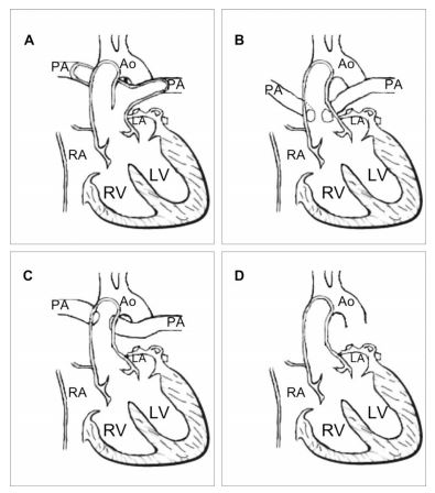Figure 3 Classification of truncus arteriosus type, according to Collet and Edwards.5
