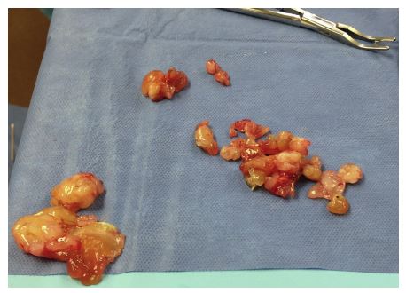 Gross appearance of the multinodular gelatinous mass at the time of surgical debulking