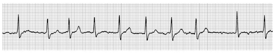 Lead II of a six lead paper trace ECG (20 mm/mV, 50 mm/s) with the cat in right lateral recumbency revealed variable R to R intervals and no visible P waves