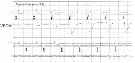 Pacemaker interrogator report from dog 2 displaying ECG leads I, II, and III and the ventricular endocardial electrogram