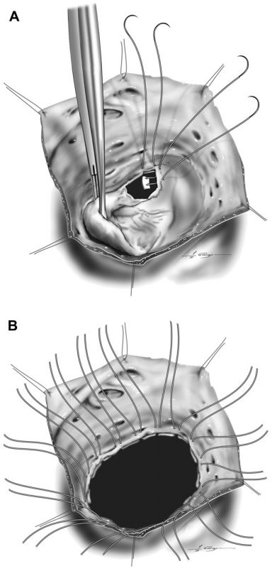 Pledget-buttressed mattress sutures were placed into the valve annulus with the pledget oriented on the ventricular side of the annulus
