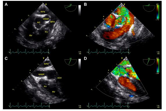 Pre-operative transesophageal echocardiographic images
