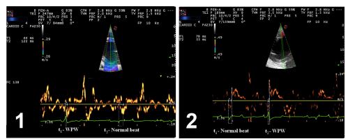 Pulse wave tissue doppler image evaluation of 1) right parasternal short-axis view at chordal level of the right and left ventricles, with the focus positioned in interventricular septal wall