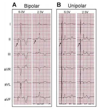 Representative QRS complexes from a 6-lead ECG from dog 2