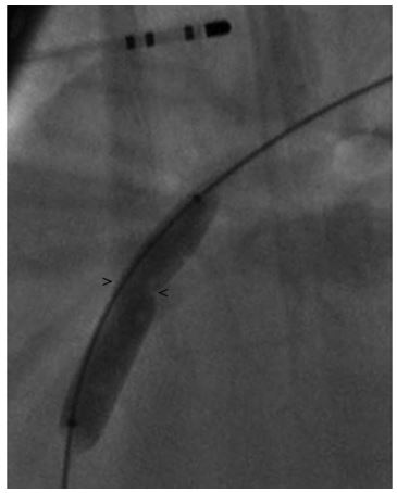Right lateral fluoroscopic image demonstrating a balloon dilation catheter inflated across the PDA resulting in a waist at the MDD