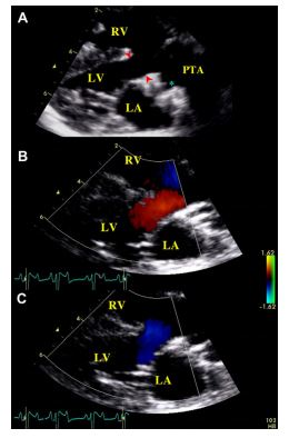 Right parasternal long axis view of the heart showing the interventricular septal defect