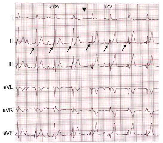 Six-lead ECG from dog 1 demonstrating an acute change in the paced QRS complex morphology associated with a decrease of the paced output amplitude from 2.75 V to 1.0 V 