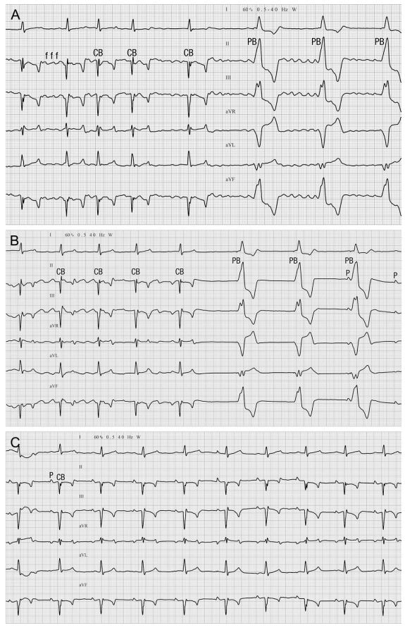 Six lead electrocardiogram recorded from a dog during pacemaker implantation for treatment of collapsing with long sinus pauses