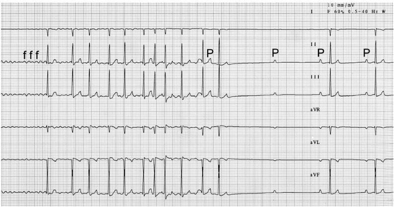 Six lead electrocardiogram recorded from a dog with atrial fibrillation (AF) that was associated with circumstances of elevated parasympathetic tone