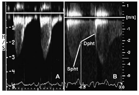 Spectral Doppler findings in cats 3 (A) and 7 (B) and technique used to identify diastolic Doppler measurements