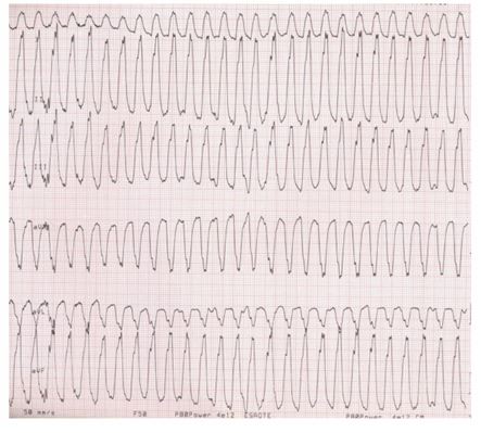 This electrocardiogram from a Dobermann shows a wide complex ventricular tachycardia