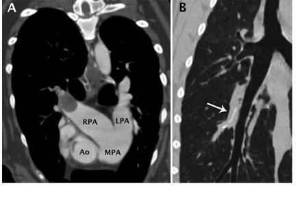 Transverse computed tomographic images post-contrast in a mediastinal window and precontrast dorsal multiplanar reconstruction in a lung window