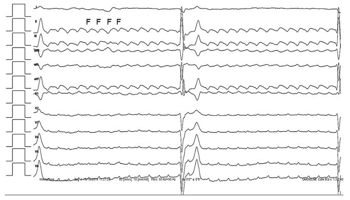 Twelve-lead surface ECG of a dog referred for repeated episodes of exercise-induced syncope