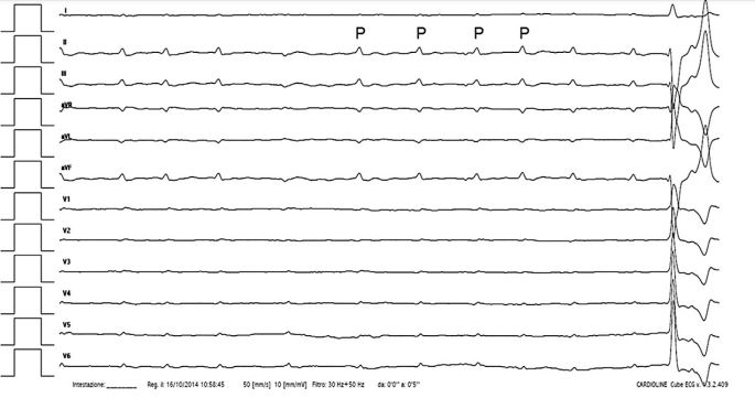 Twelve-lead surface ECG recorded from a dog with sinus arrhythmia and third-degree atrioventricular block