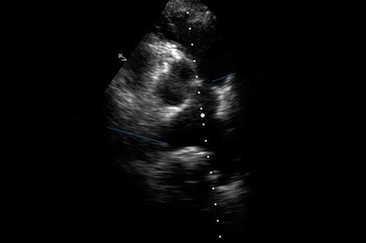 Эхокардиографическая диагностика стеноза устья легочной артерии