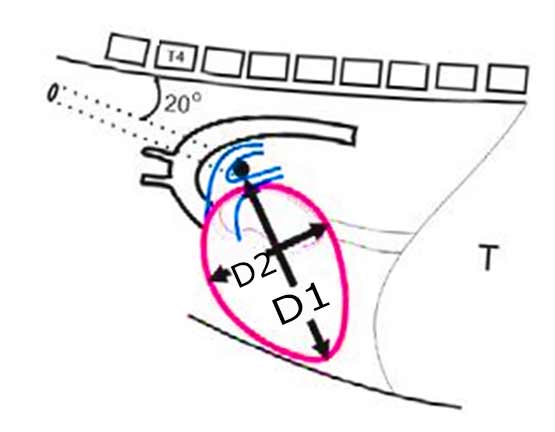 Схема расчета коэффициента Бьюкенана по правой латеральной рентгенограмме