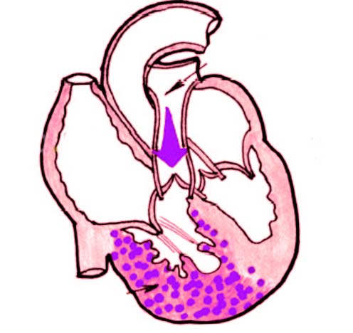 Электрокардиографическая (ЭКГ) диагностика гипертрофии миокарда правого желудочка