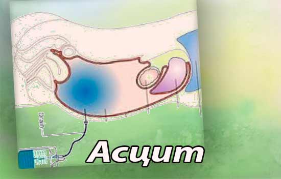 Асцит или брюшная водянка – синдром, осложняющий заболевания с тяжелым прогнозом