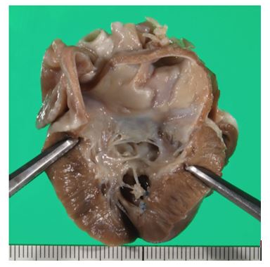 Левая сторона сердца у 3-летнего кастрированного самца короткошерстной кошки с эндомиокардиальной формой рестриктивной кардиомиопатии (РКМП)