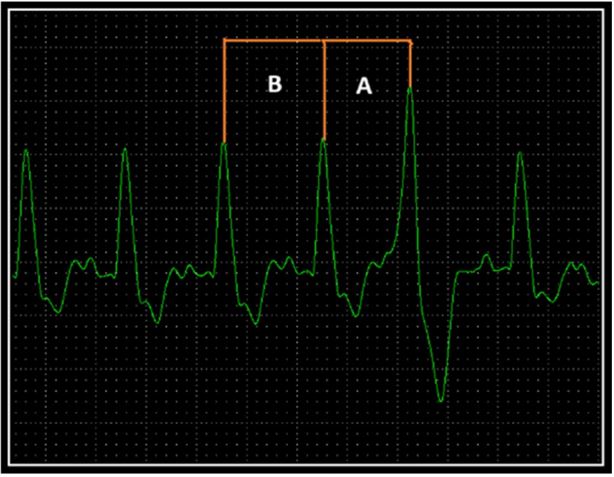 Схема, показывающее измерение и длительность синусового цикла, а также расчет индекса преждевременности (A: B) в отслеживании II отведения ЭКГ
