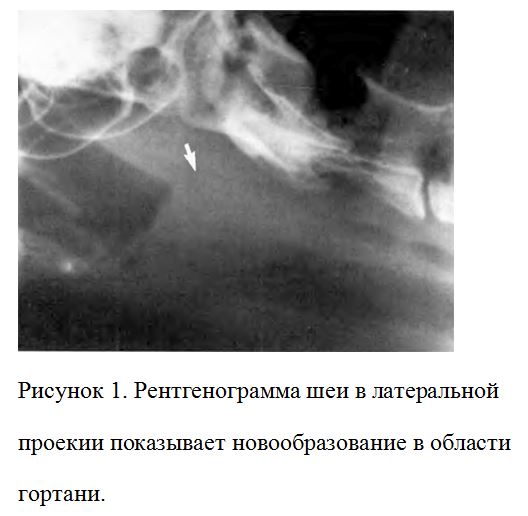 Рентгенограмма шеи в латеральной проекии показывает новообразование в области гортани