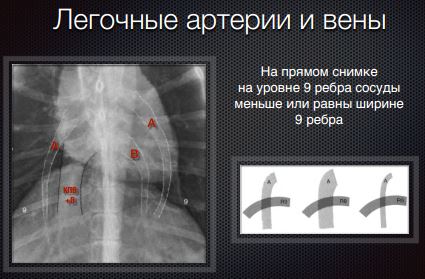 Методика реализации правила квадратиков для интерпретации рентгенографического изменения диаметра легочных периферических вен и артерий