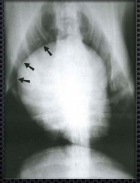 рентгенограмма собаки, выполненная в вентро-дорсальной проекции, при увеличении тени правого предсердия