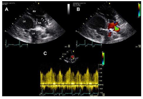 2D right parasternal skewed four chamber echocardiographic view