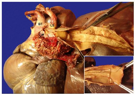 A 1-cm transversal tear was identified adjacent to the origin of the left subclavian artery