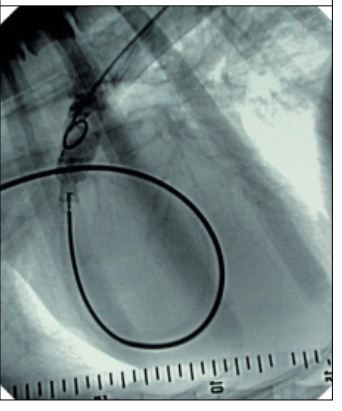 Angiography by hand injection of contrast medium into to the ampulla after duct occlusion using an Amplatzer, duct occluder