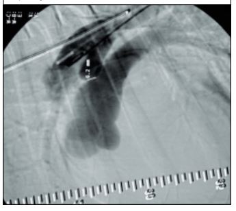Angiography of a patent ductus arteriosus in a 10- month-old, female German shepherd dog