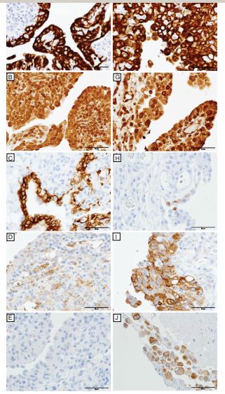 Atypical mesothelium with the expected staining pattern