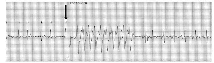 Cardioversion strip showing a run of ventricular tachycardia lasting approximately 3.8 s which has been initiated by the shock (arrow). The tachycardia spontaneously converts to sinus rhythm