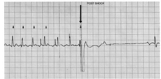 Cardioversion strip showing brief arrhythmia immediately after delivery of biphasic shock