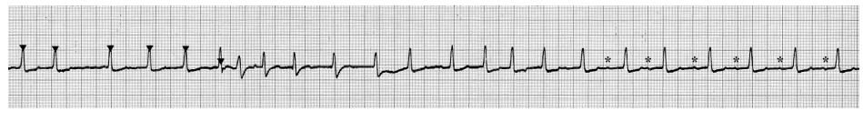 Cardioversion strip showing return to normal sinus rhythm following a brief arrhythmia