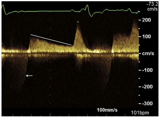 Continuous wave Doppler assessment of right ventricular inflow obtained from Case 1 using a left apical four-chamber view