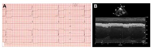 ECG (A) and echocardiogram (B) after cardioversion to normal sinus rhythm