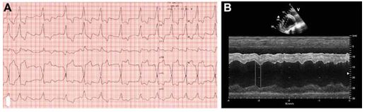 ECG (A) and echocardiogram (B) at the time of presentation