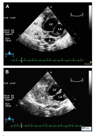 Echocardiographic images following injection of agitated saline in a dog suspected to have cor triatriatum dexter.