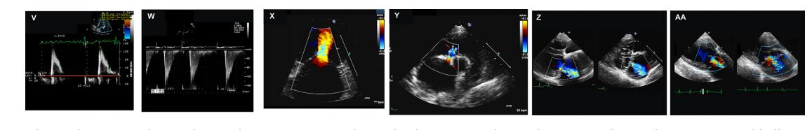 Echocardiographic images from 2 dogs with severe congenital mitral valve stenosis that underwent cardiac catheterization and balloon valvuloplasty