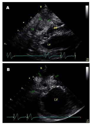 Echocardiographic right parasternal long axis four chamber (A) and short axis (B) views