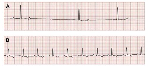 Electrocardiogram during initial admission of dog showing sinus bradycardia 