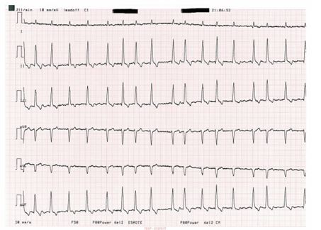 electrocardiogram from a Newfoundland dog with dilated cardiomyopathy