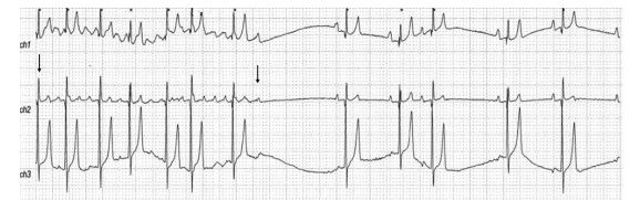 Electrocardiogram recorded after a syncopal episode in a 7 year old male mixed breed