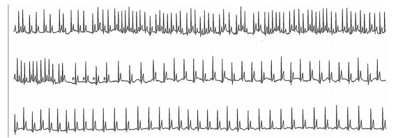 Electrocardiogram recorded after a syncopal episode in a 9 year old male Boxer